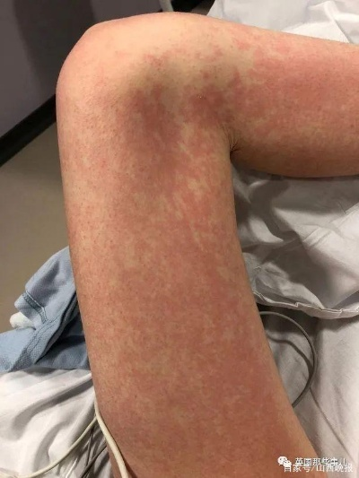 输液过敏悲剧，曾要求皮试却被拒，花季女生离世引深思