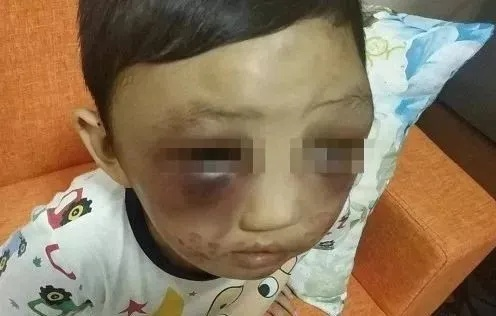 孩子一觉醒来脸肿成发面馒头，揭秘儿童突发肿胀的神秘面纱