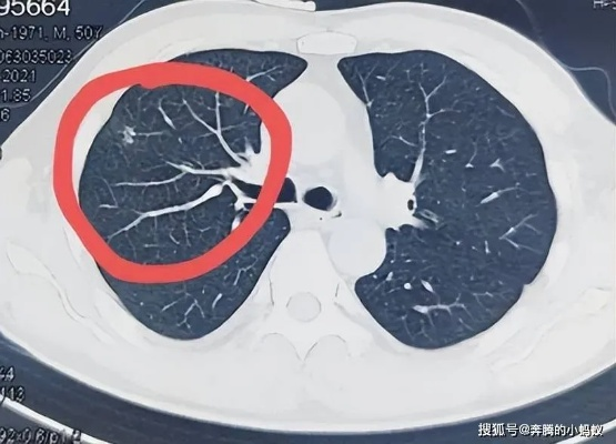 27岁女子肺结节未重视，1年后确诊肺癌，年轻不是借口，健康意识需提高